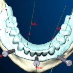 Modélisation dentaire 3D